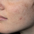 Skin tone before beginning the Vetra Method