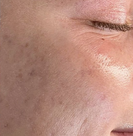 Skin barrier after twelve weeks with the Vetra Method
