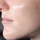 Skin tone after twelve weeks with the Vetra Method