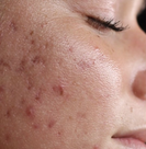 Skin barrier before beginning the Vetra Method
