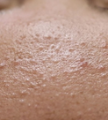 Skin texture before beginning the Vetra Method