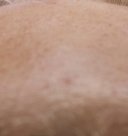 Skin texture after twelve weeks with the Vetra Method